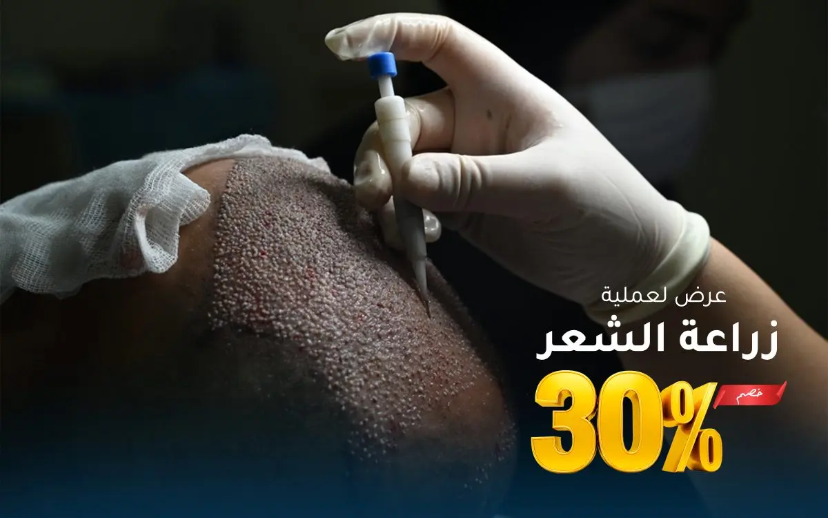 عرض خاص: زراعة الشعر — خصم 30%