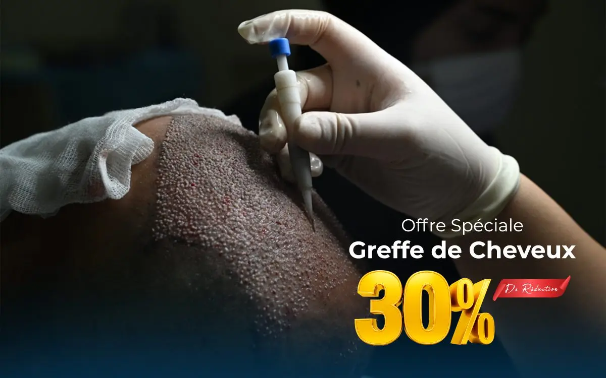 Offre spéciale : greffe de cheveux — 30 % de remise