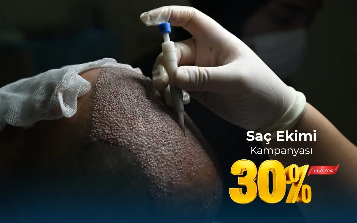 Saç Ekimi kampanyası — %30 indirim