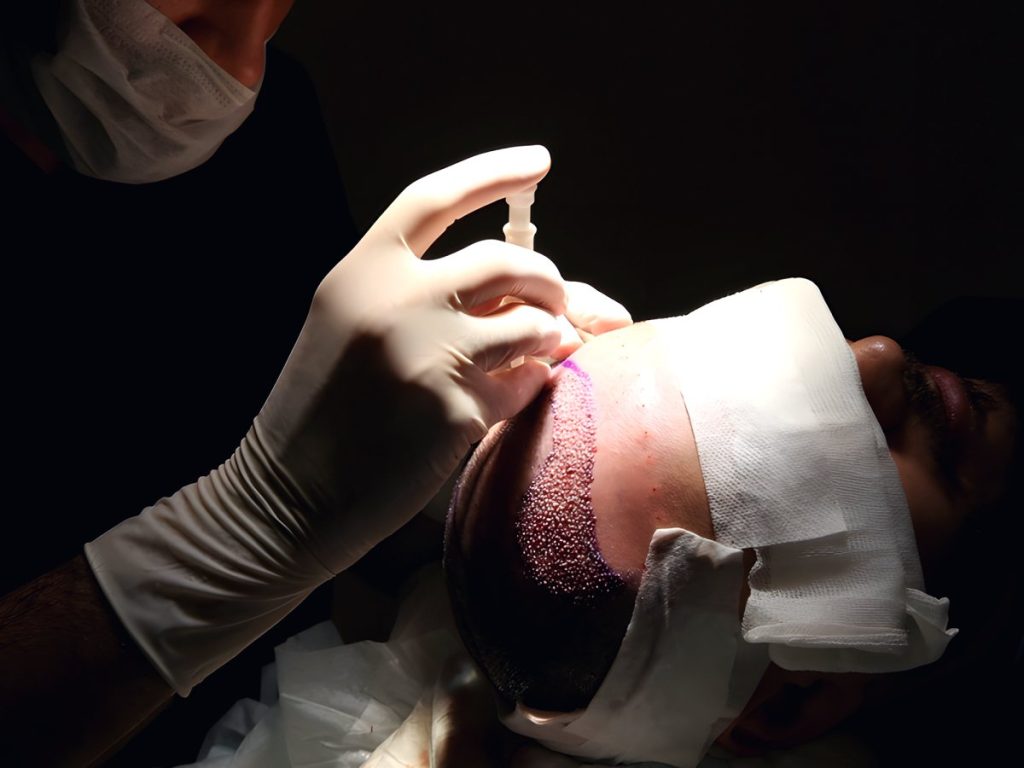 زراعة الشعر بتقنية DHI: دليل المريض