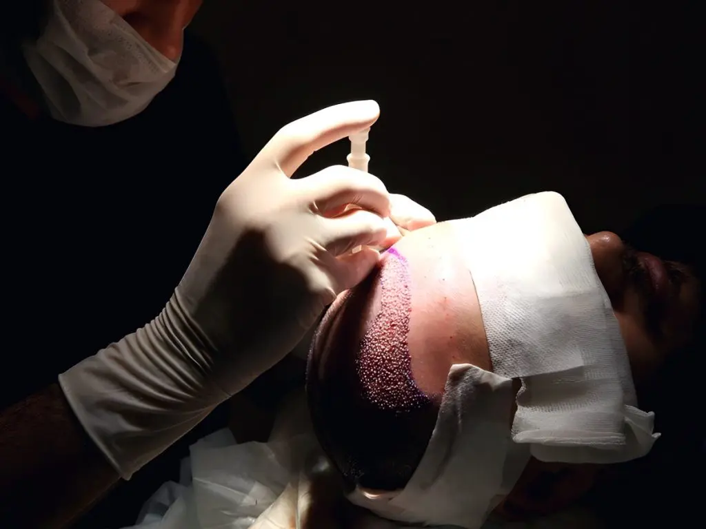 Hair Transplantation