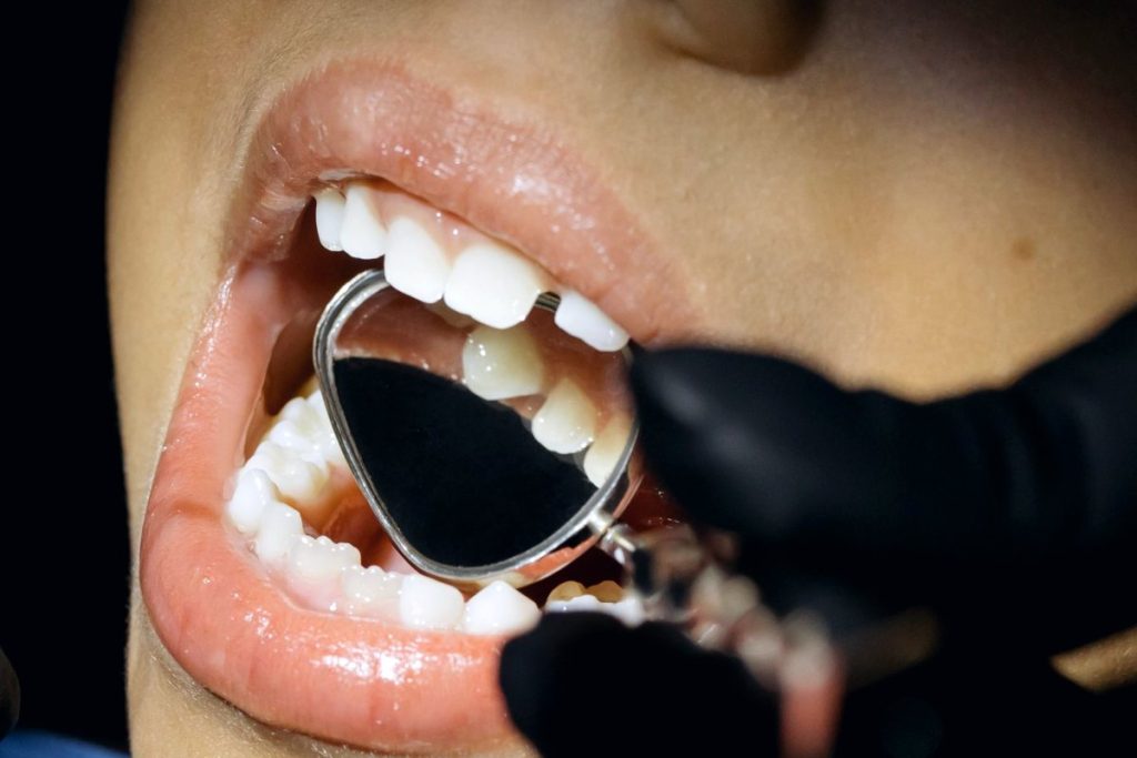 Hollywood Smile and Veneers: A Patient Guide