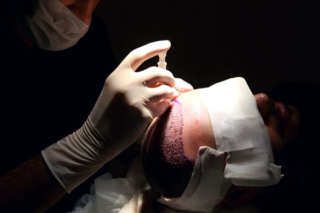 زراعة الشعر في تركيا: الدليل الكامل
