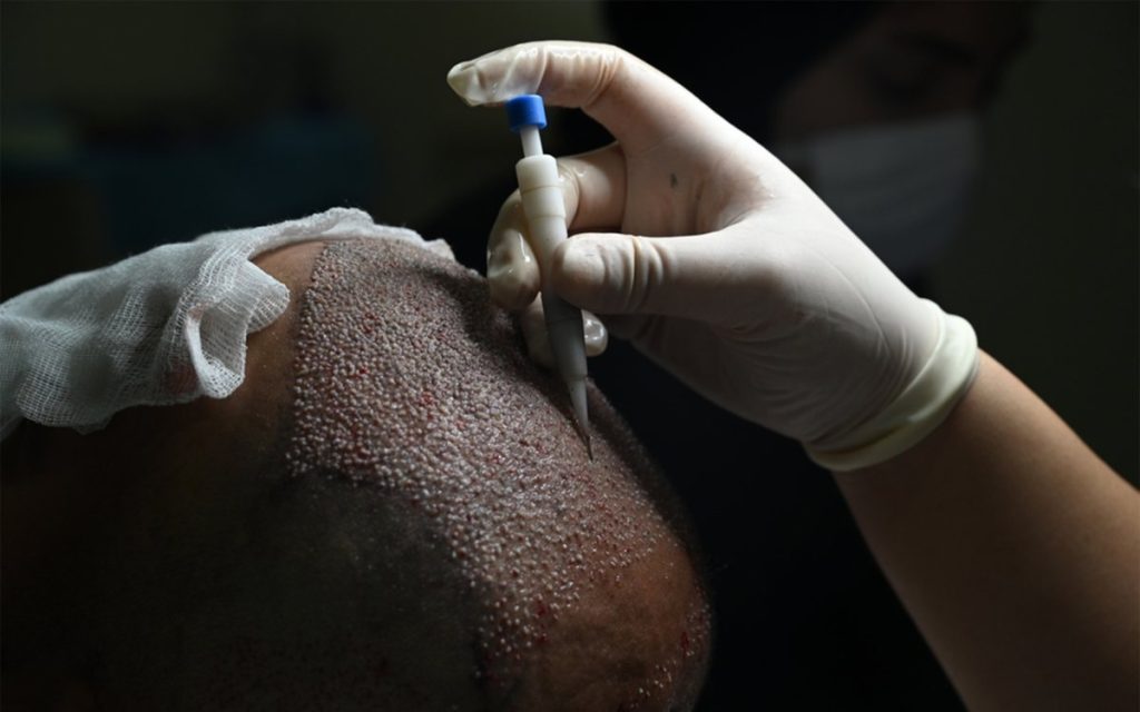 إجراء زراعة الشعر — Jelan Clinic
