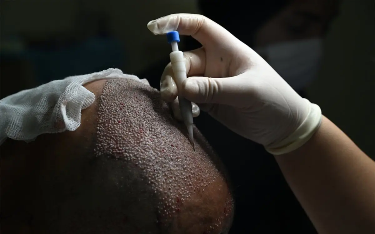 Hair transplant procedure