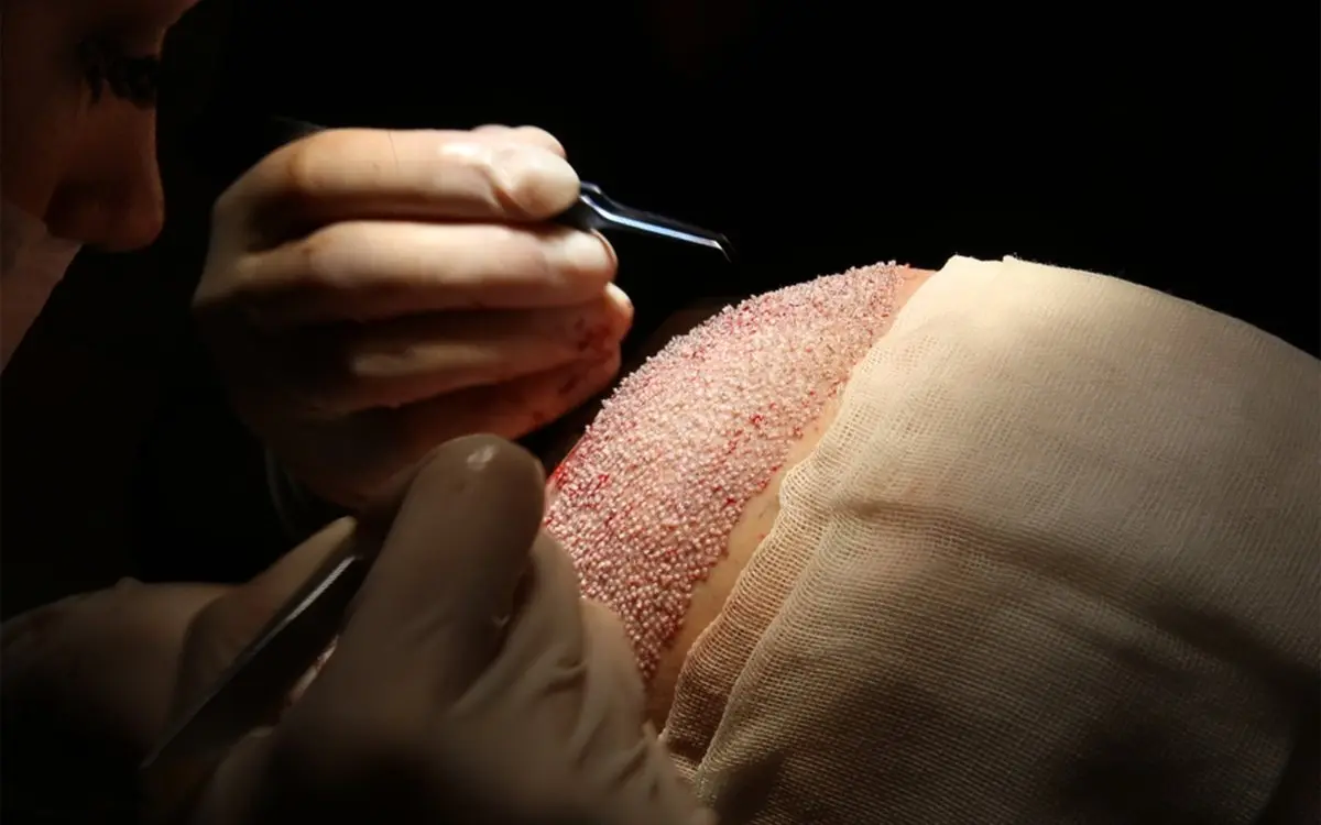 Hair transplant close-up