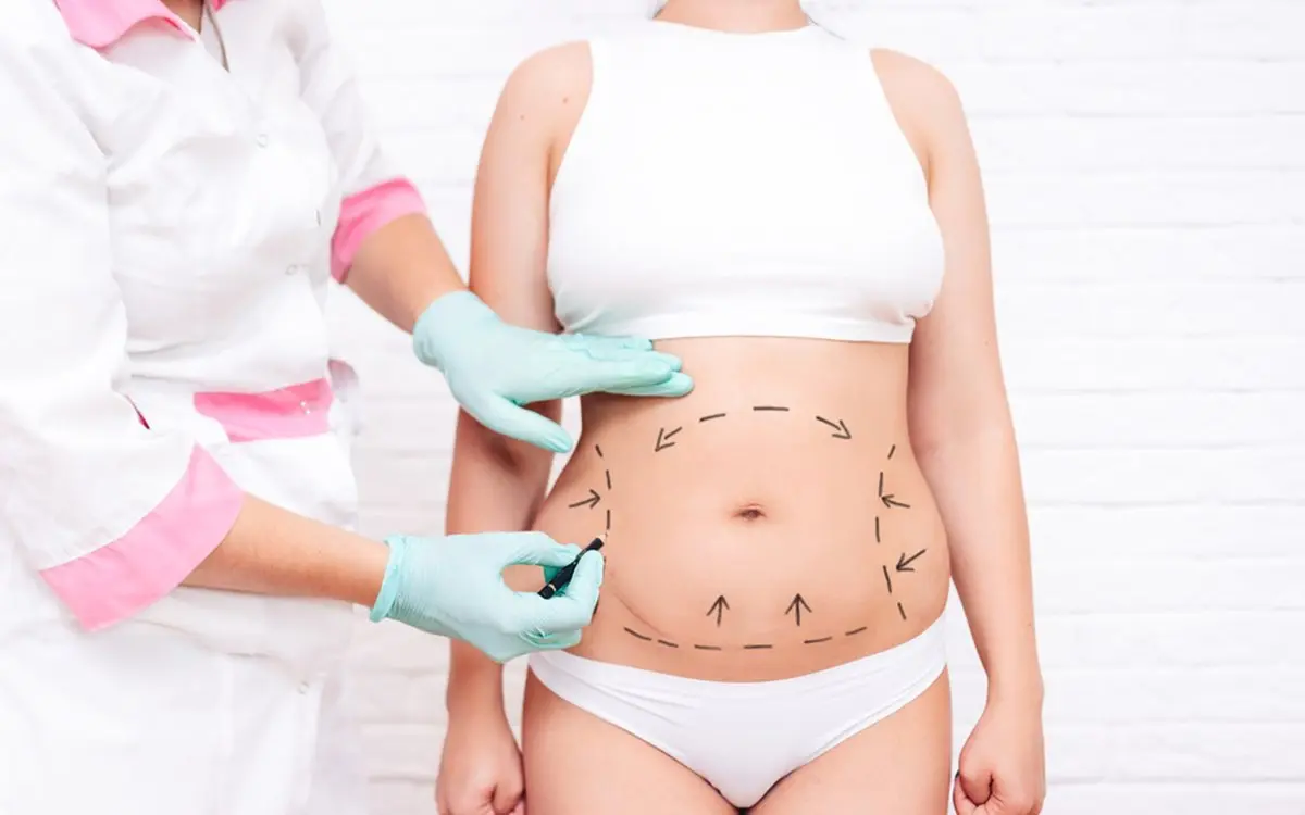 Abdominal contour marking
