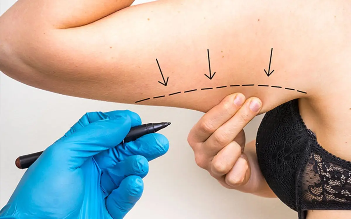 Arm liposuction marking