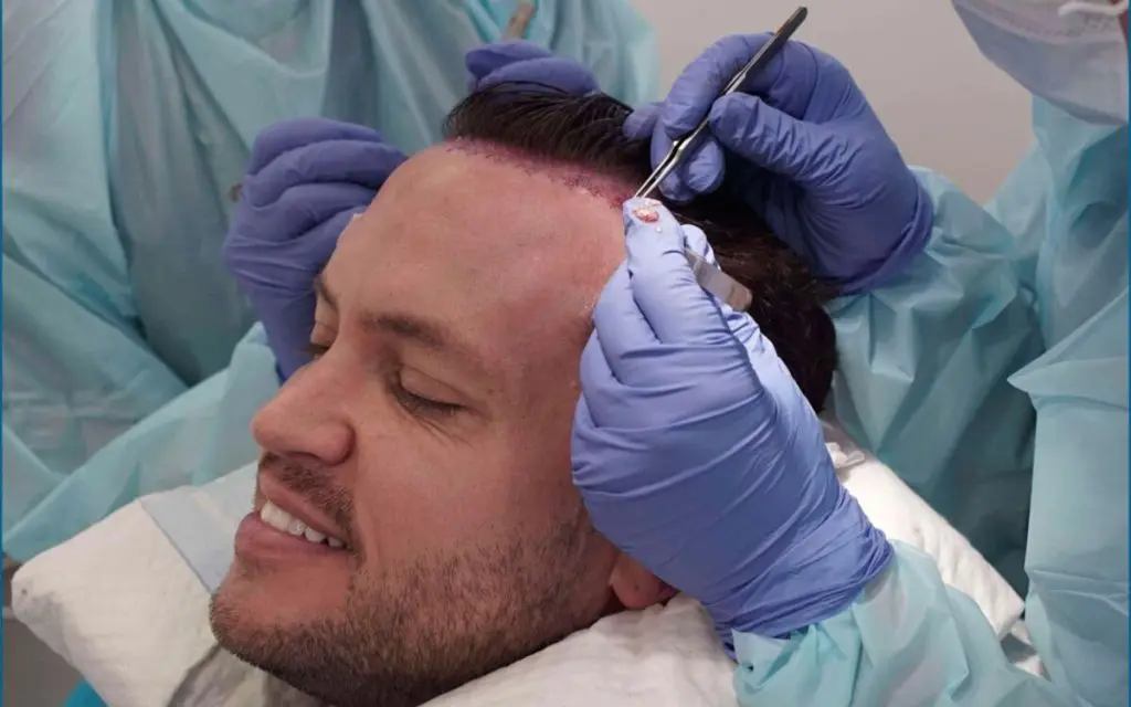 Hair Transplantation