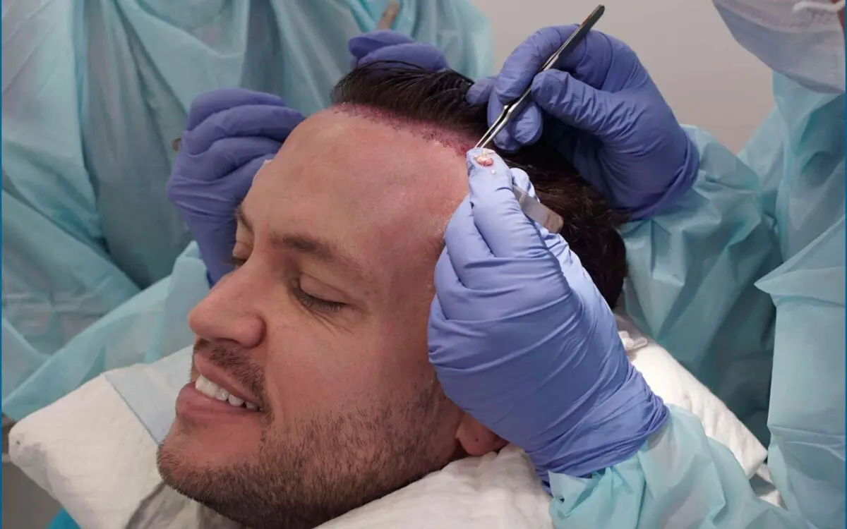 Hair transplant session