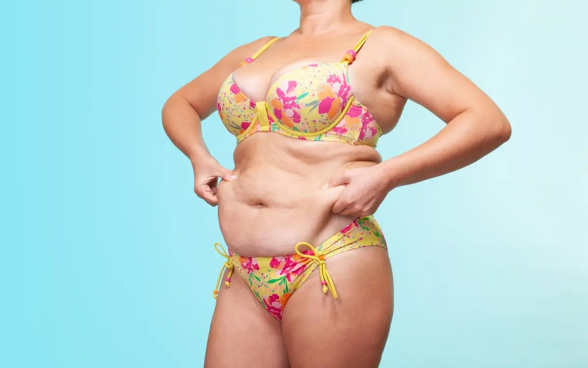 Body contouring result