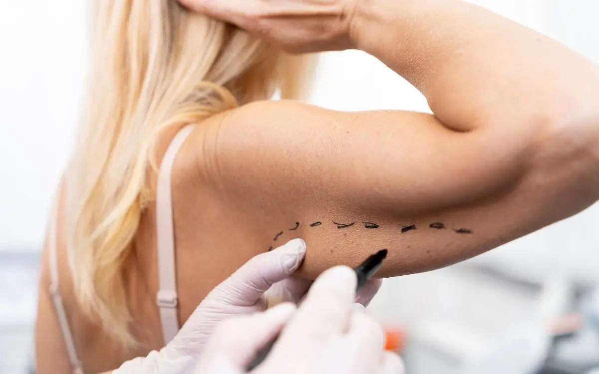 Arm treatment marking