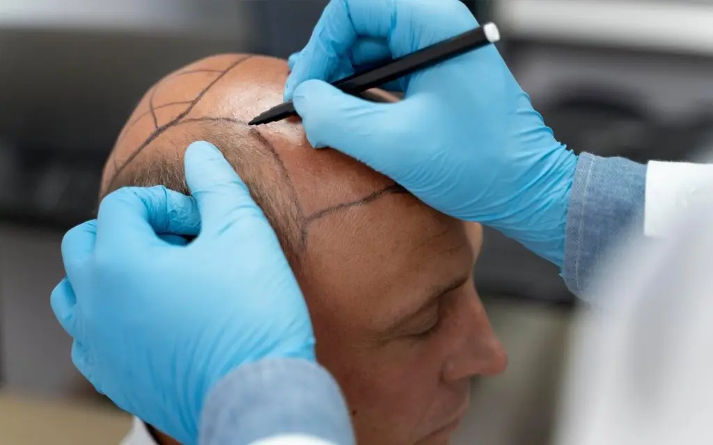 Hair Transplant Expectations: Discussing the Outcome Before the Session