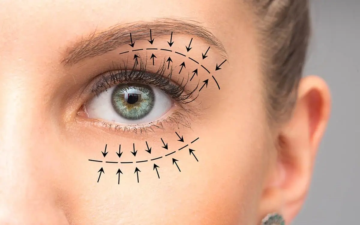 Eyelid surgery marking