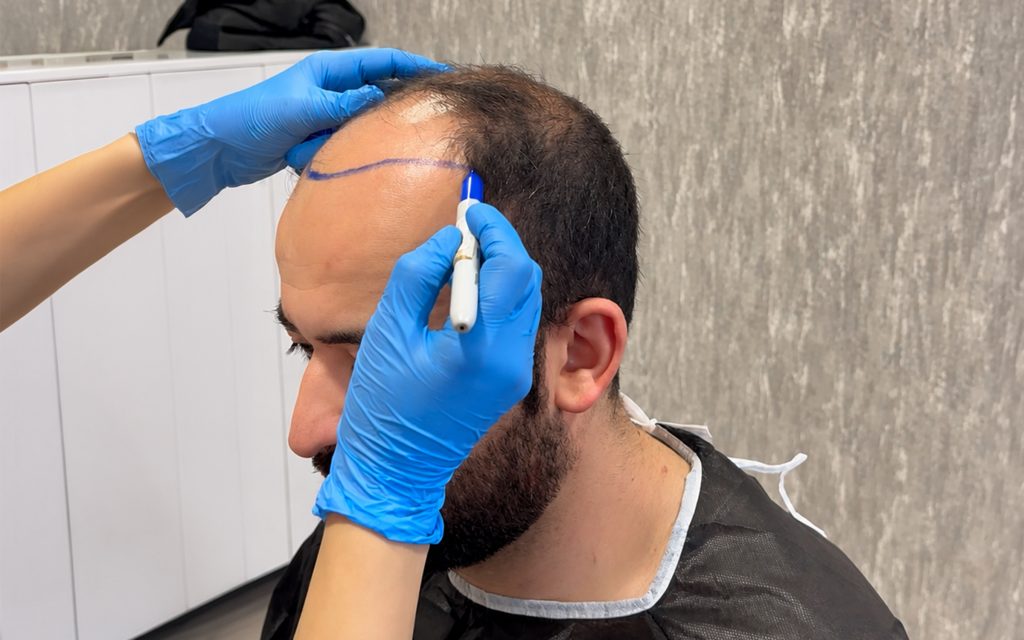 Hair Transplant Recovery Timeline
