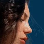تجميل الأنف — شكل طبيعي متناسق