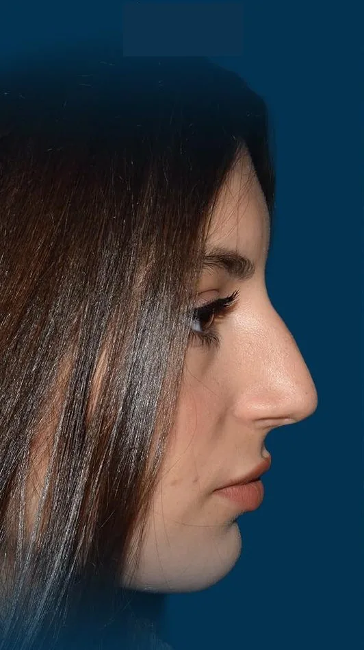 Remote Aftercare After Rhinoplasty: How Follow-Up Works From Abroad