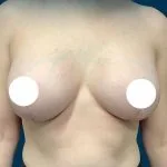 تكبير الثدي — زرعات دائرية ناعمة 390cc