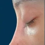 تجميل الأنف — منظر جانبي