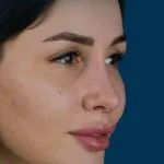 تجميل الأنف — زاوية ثلاثية