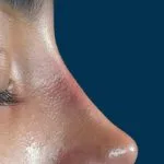 تجميل الأنف — منظر جانبي