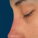 تجميل الأنف — منظر جانبي