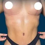 نحت الجسم — شفط بالفيزر 360 · شدّ البطن · شدّ الثدي