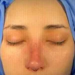 تجميل الأنف — منظر أمامي