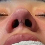 تجميل الأنف — منظر سفلي