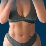 نحت الجسم — شفط بالفيزر 360 · شدّ البطن